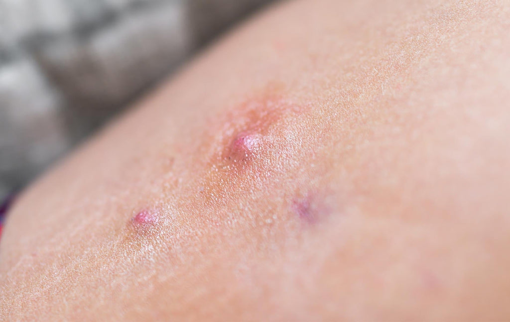 Hidradenitis Suppurativa (HS) bumps