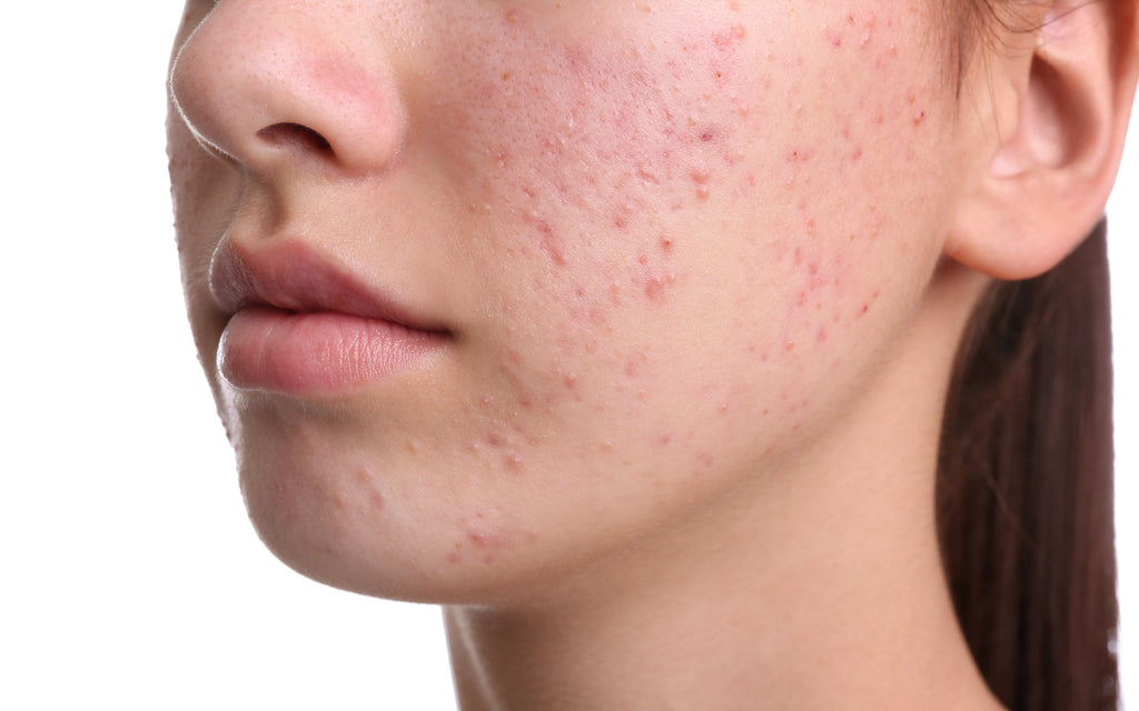 How to get rid of acne scars naturally?