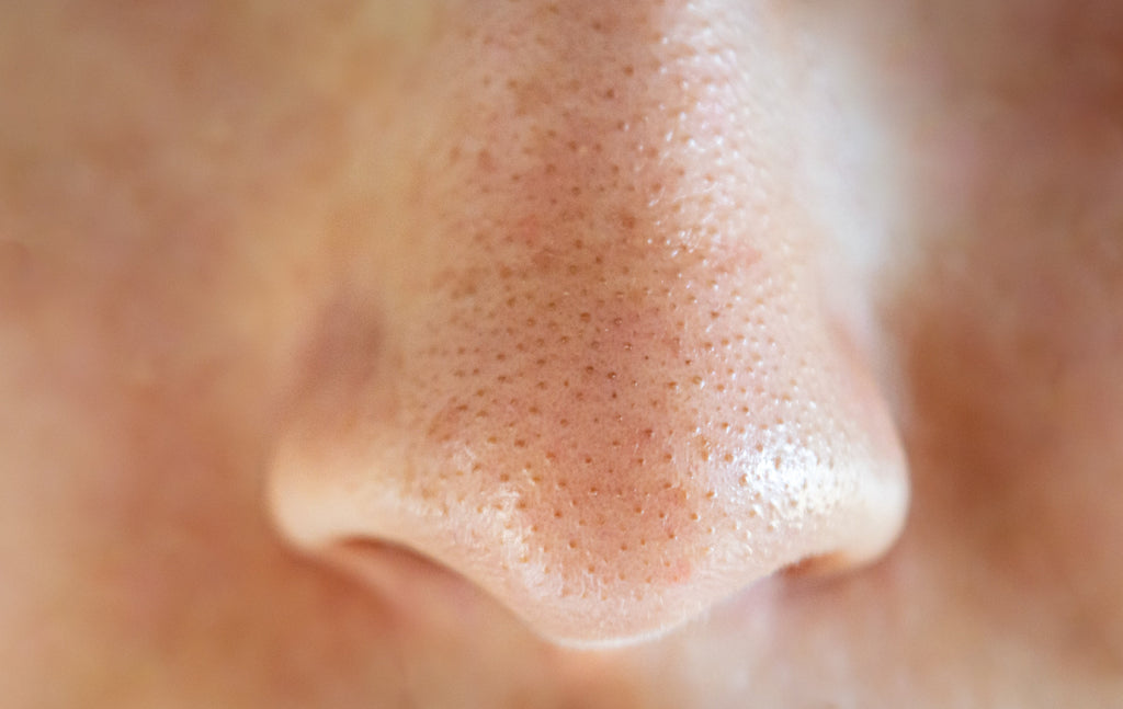 How to Get Rid of Blackheads Naturally in 3 Easy Steps